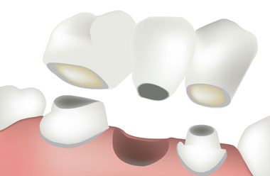 Couronne, ponts, facette et esthétique